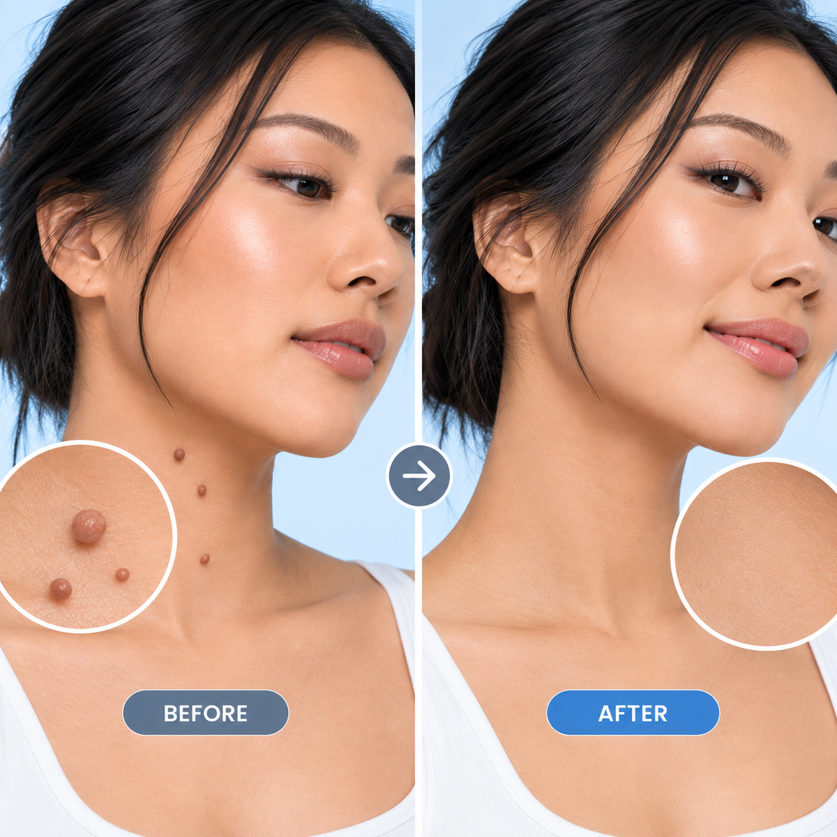 Precision Skin Tag Remover