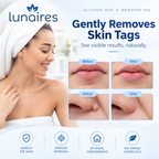 Precision Skin Tag Remover